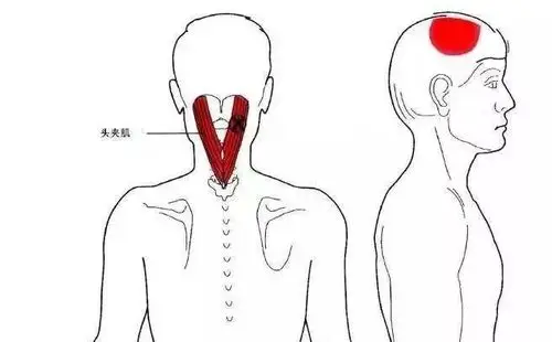 头夹肌及颈夹肌(splenius capitis and cervicis)脖子僵硬,就是血浊