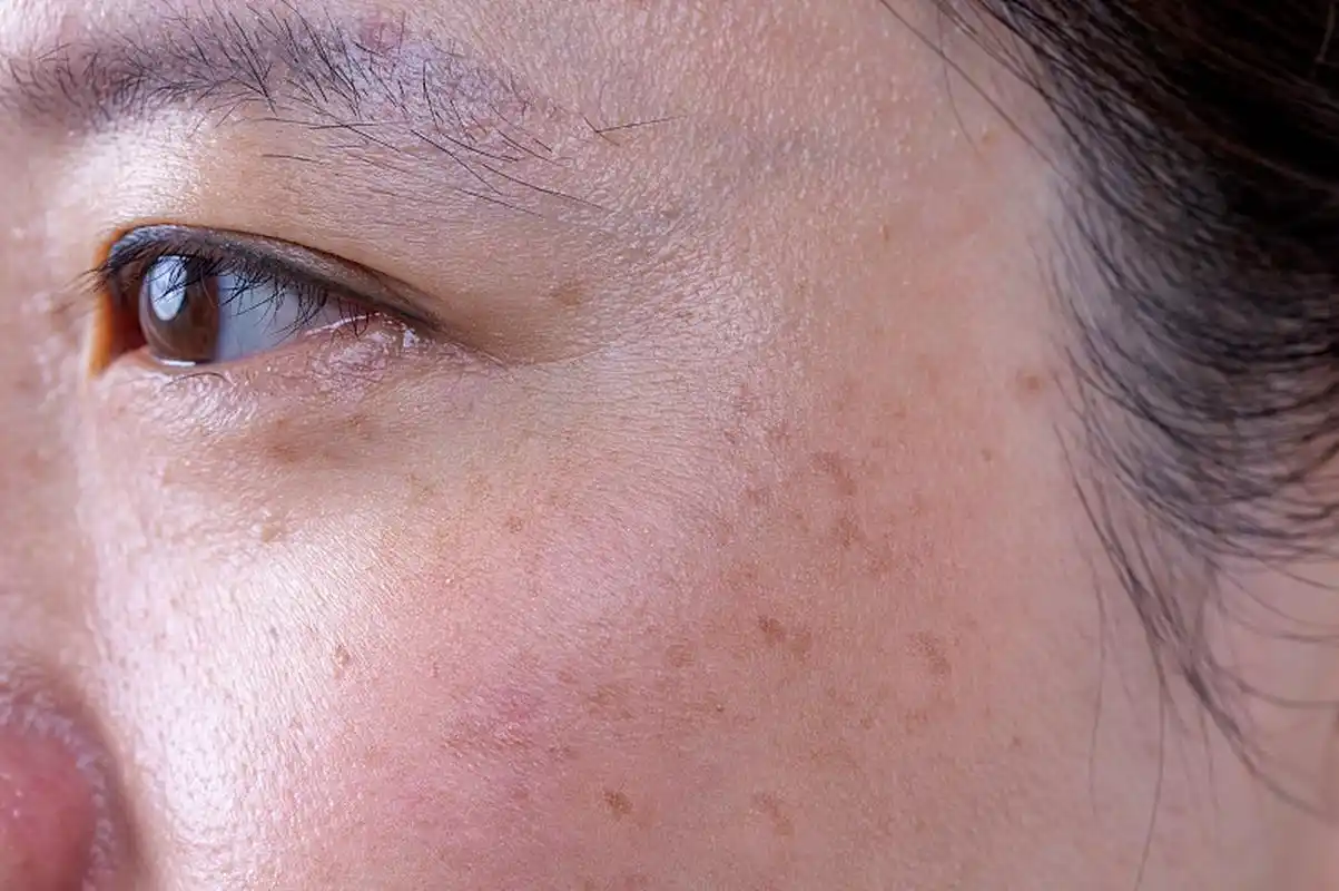 皮肤容易长斑,这几种体质,在作怪!  大家好,我是中医屠远辉.中医认为,