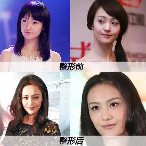 郑爽整形前后对比照郑爽整形前后对比照
