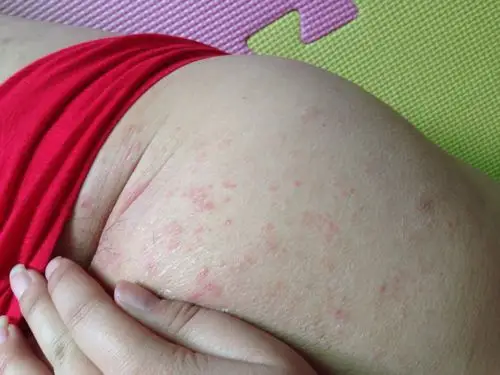 男生夏天屁股上长红色的斑不痛偶尔痒痒