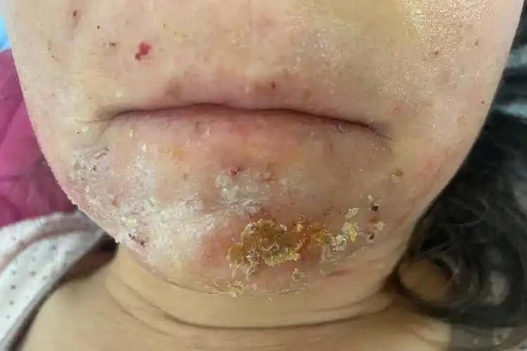 湿疹型药疹皮损图