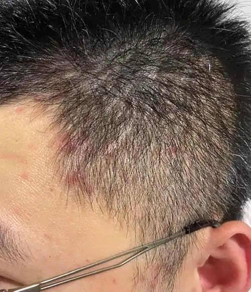 头皮上的红点有什么办法?