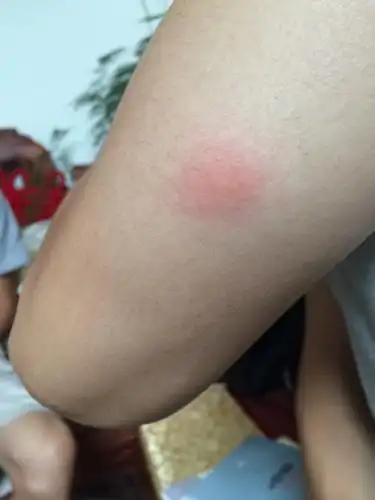 一些包包,有红,肿痒的症状,不知道是过敏还是皮疹还是水土不服什么的