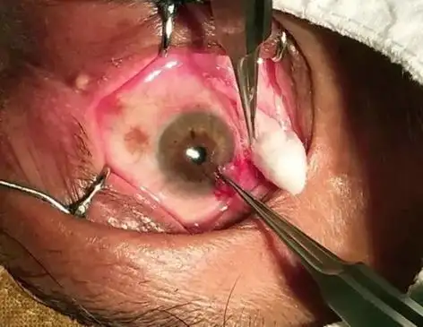 首页 眼病百科 翼状胬肉 > 翼状胬肉微创美容手术翼状胬肉手术之我见