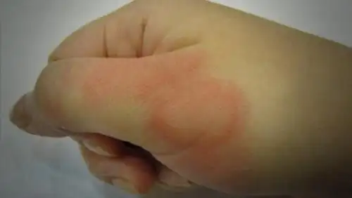 手被烫伤怎么办