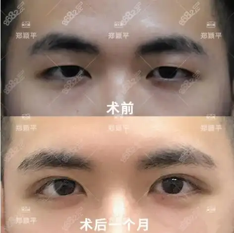 郑颖平双眼皮前后对比图2