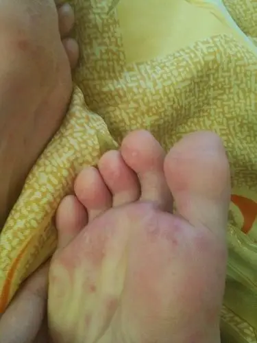 我的脚底板长了很多一粒粒白白的像水泡很痛