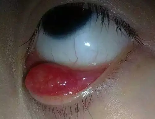 视频喝了这碗金银花蒲公英汤麦粒肿也许就好啦