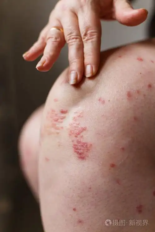 特写妇女瘙痒和抓牛皮癣斑的手. 皮肤上的银屑病或湿疹.