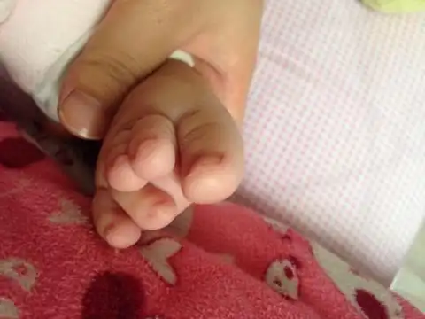 宝宝脚趾重叠
