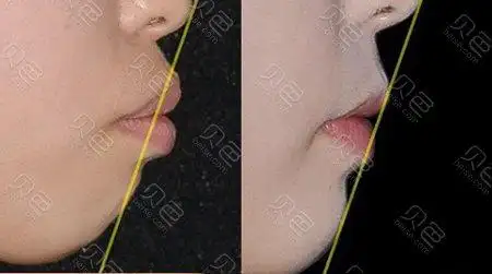 侧面牙齿矫正前后对比
