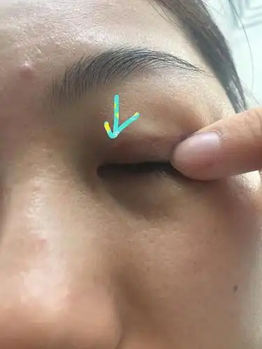 埋线,三年多了,几乎没人看出来