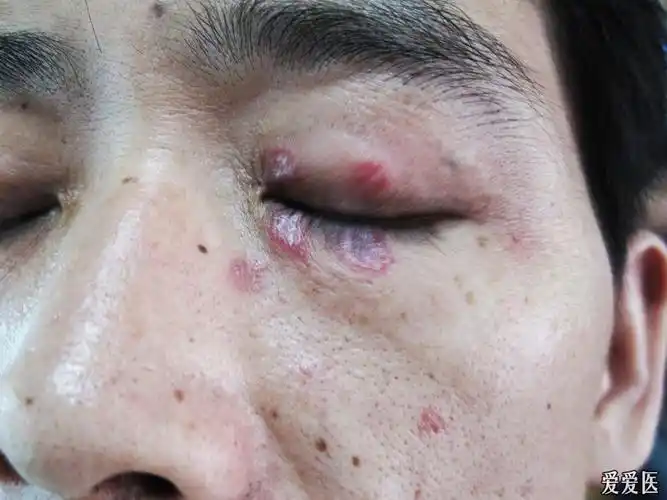 看图诊病---------皮肤型红斑狼疮