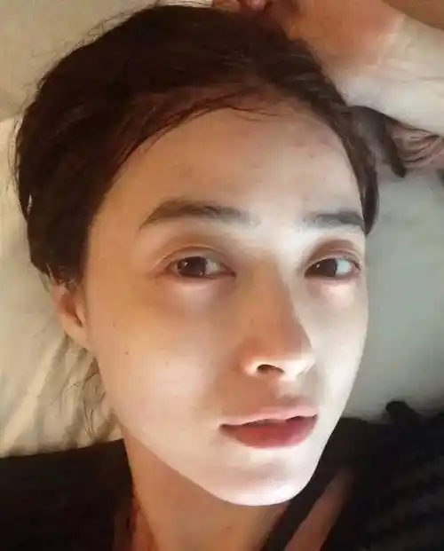 郑爽不想再"靠脸吃饭",但这颗影响颜值的痘痘,你不能不管啊!