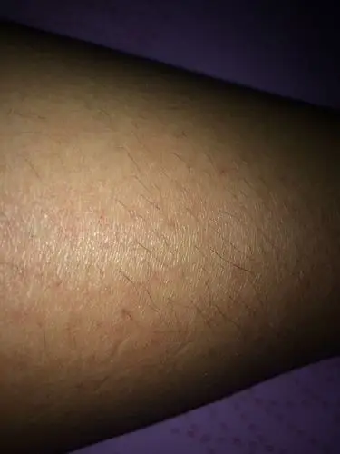 女生大腿侧面长毛怎么回事?怎么去除?很粗,不想用脱毛膏刮掉!