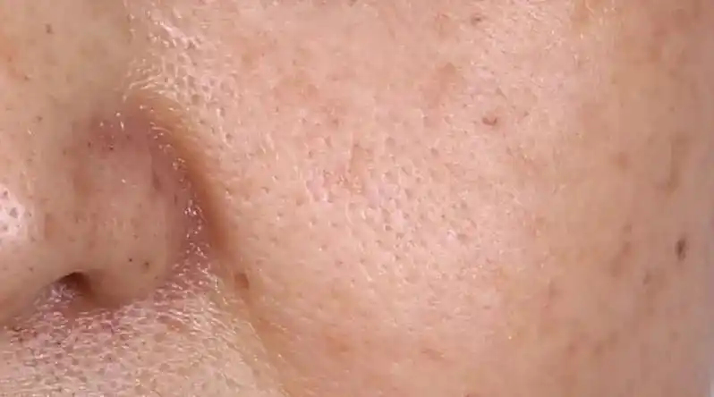 什么是衰老型毛孔粗大?该如何治疗?-周先勇主治医师-爱问医生