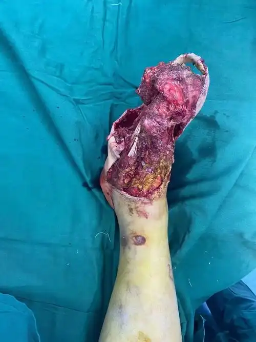 股前外侧穿支皮瓣修复术治疗右足碾压伤