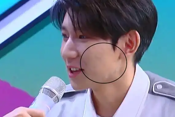 王源生图满脸痤疮 金星评价王源