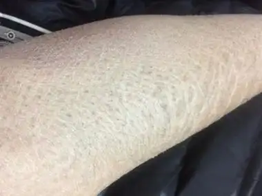 甲状腺功能减退症小腿皮肤粗糙图