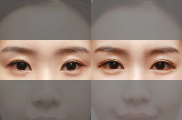 做双眼皮需不需要搭配眼部提肌