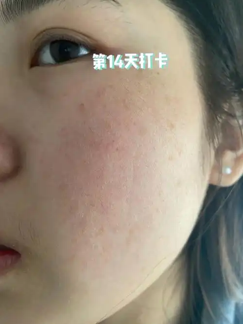 角质层受损14天