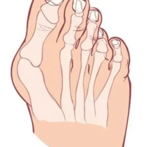 拇外翻的基础了解