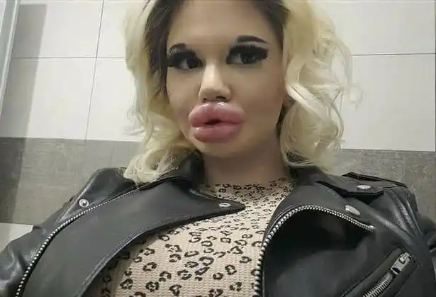 拥有世界上最大嘴唇的姑娘已注射25次玻尿酸还要继续填充下去