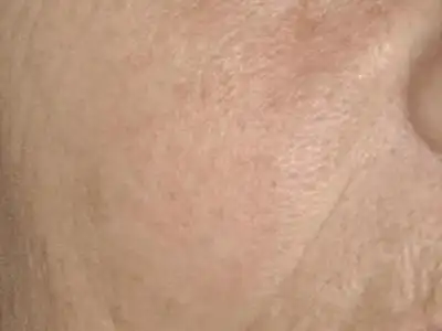 老年性皮肤萎缩