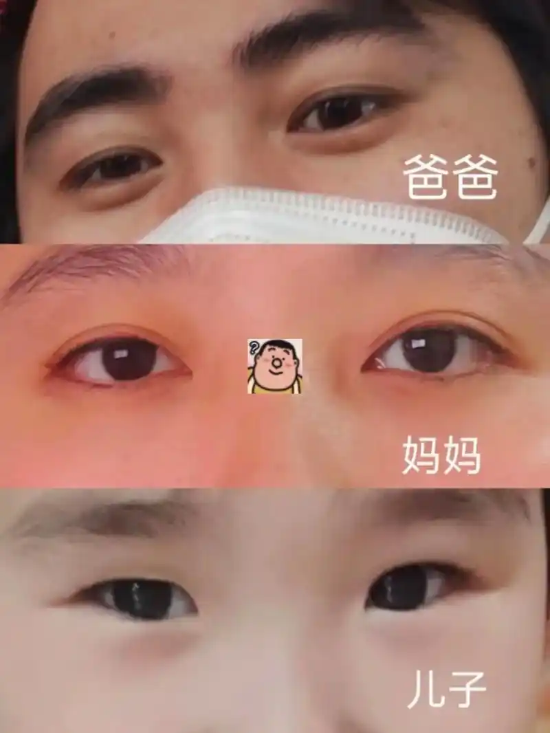 双眼皮和单眼皮是与遗传有关的特征.