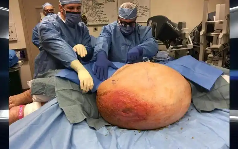 女子身上长了一个127斤的巨型肿瘤,切下来都花了整整1天!
