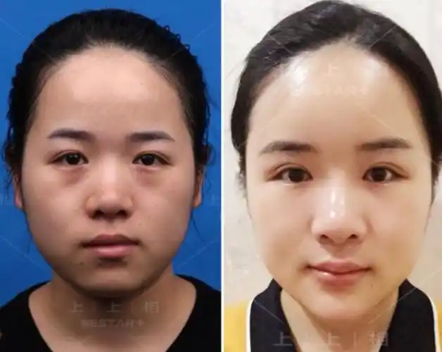 小手术大改变,上上相脂肪移植中心引领精准整形时代