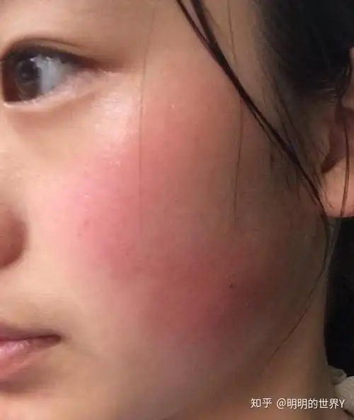 先天性红脸蛋也分为两种情况:诱因又分两类,先天性和后天造成的.