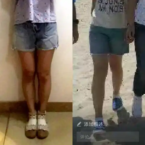 姐妹们我腿弯算严重吗