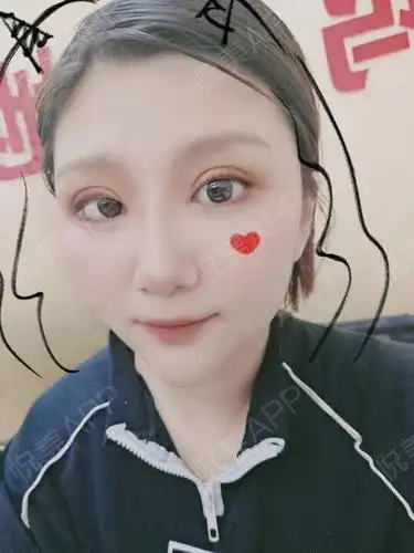 全切双眼皮术后8天_双眼皮术后8天_眼部整形术后8天_栀梦分享图片2