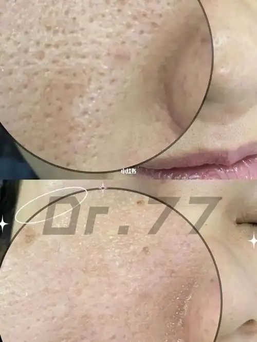 淄博 dpl超光子嫩肤_光子嫩肤_收缩毛孔_淄博攻略_相机_dpl超光子嫩肤