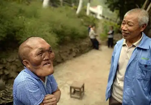 重庆"大头"男子患似外星人 比正常人头颅大2倍!