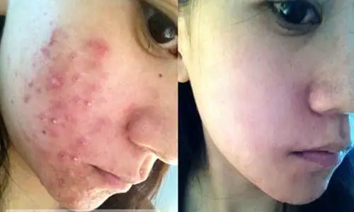 广州激光祛痘都有什么样的效果?