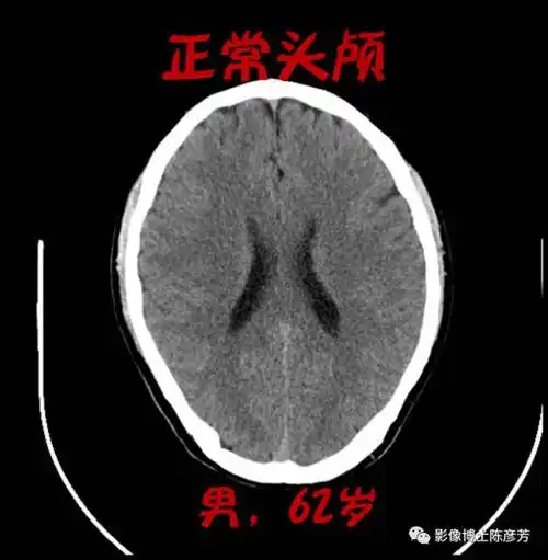 我的目的不是让大家学习阅读ct片,是想通过这些鲜活的例子让大家了解