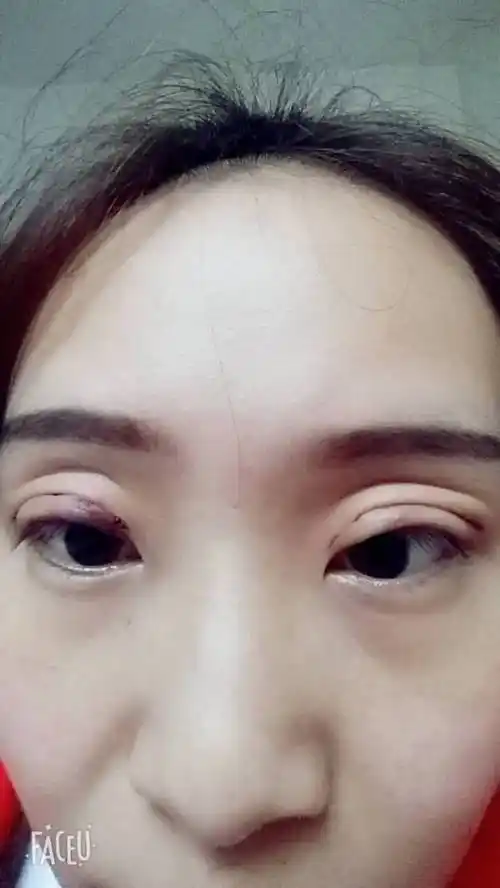我埋线做双眼皮今天第五天了,一个眼睛觉得没有双眼皮一样的?