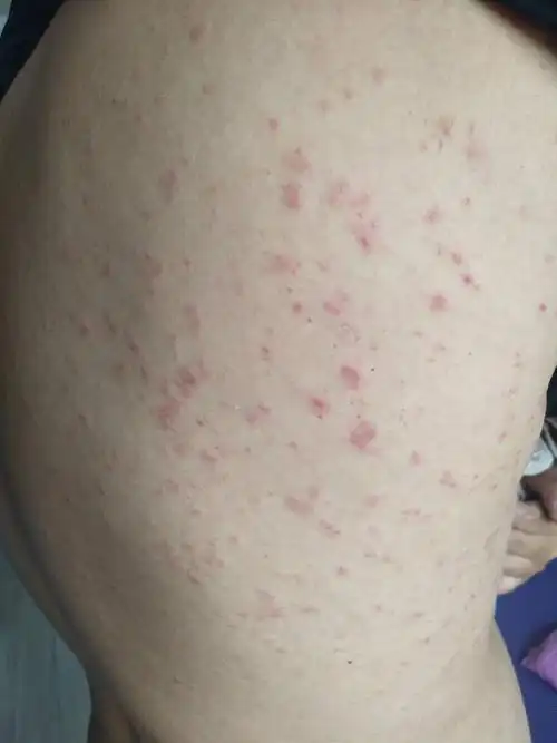 全身起红疙瘩很痒?快找出病因吧(全身性红疹)-52线报网