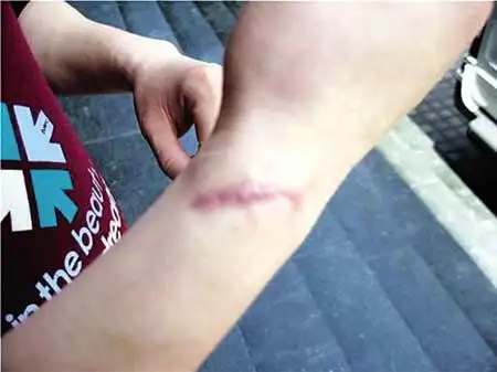 钟先生手上被砍伤的疤痕