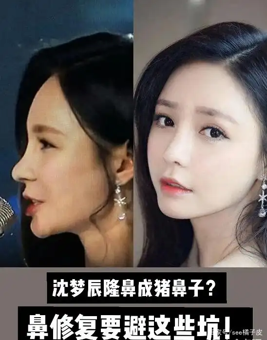 沈梦辰隆鼻成猪鼻子?鼻修复要避这些坑!