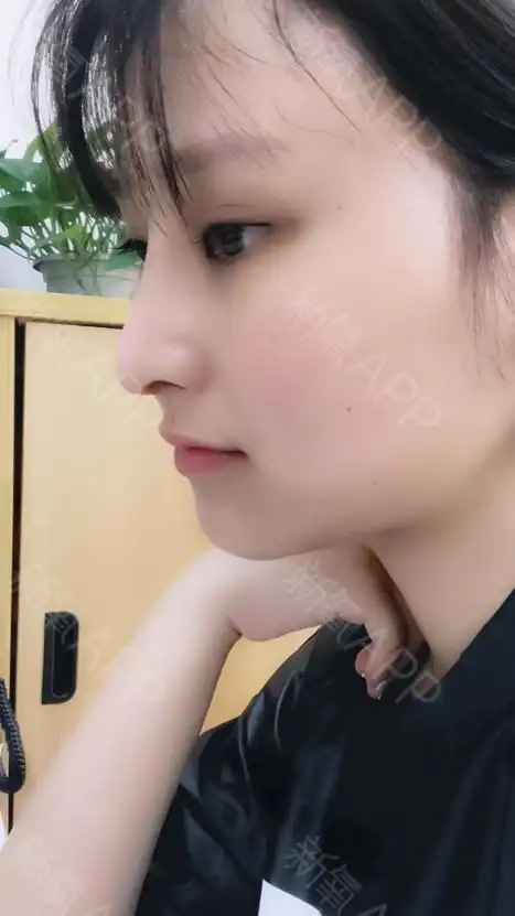 手术缩鼻翼好不好_效果图_t维若t手术缩鼻翼术后第58天_新氧美容整形