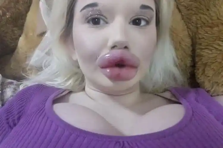 拥有世界上最大嘴唇的姑娘已注射25次玻尿酸还要继续填充下去