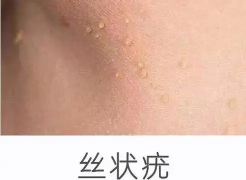 低危型hpv感染1,皮肤症状①寻常疣:米粒大小的丘疹,表面角化明显,粗糙