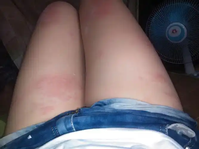 腿上长这东西什么情况啊