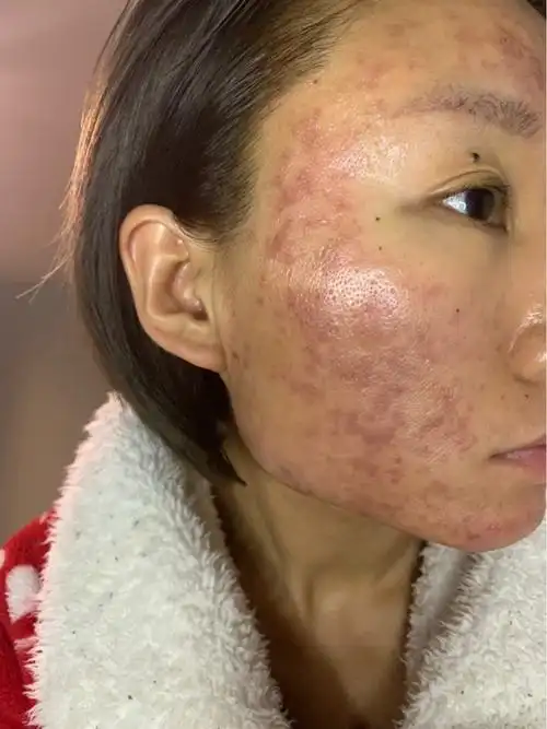 刷了一次果酸脸就成这样了快过年了不知道该怎么办0101_圈子-新氧