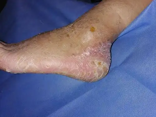 骨横搬治疗糖尿病足一例