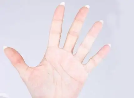 女人左手掌有痣代表什么