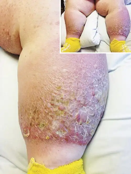 疣状非丝虫性象皮病一例